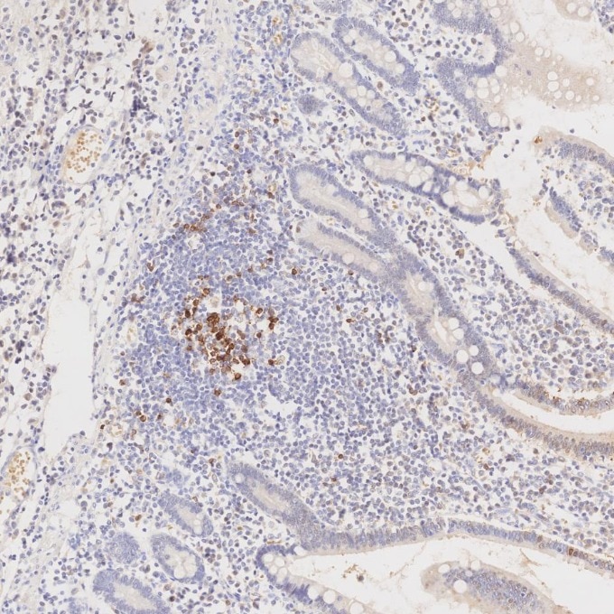IHC staining of human lymphoma using 66220-1-Ig Immunohistochemistry (IHC) staining of human lymphoma tissue using PD-1/CD279 Monoclonal antibody (66220-1-Ig)
