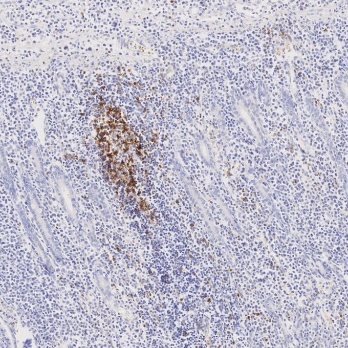 IHC staining of human lymphoma using 98068-1-RR Immunohistochemistry (IHC) staining of human lymphoma tissue using Anti-Human PD-1/CD279 Rabbit Recombinant Antibody (98068-1-RR)