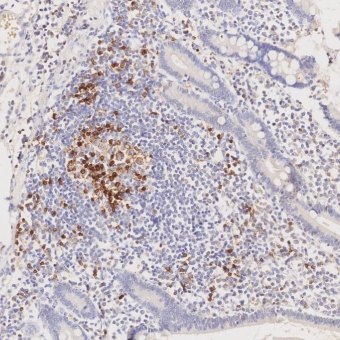 IHC staining of human lymphoma using 98068-1-RR Immunohistochemistry (IHC) staining of human lymphoma tissue using Anti-Human PD-1/CD279 Rabbit Recombinant Antibody (98068-1-RR)