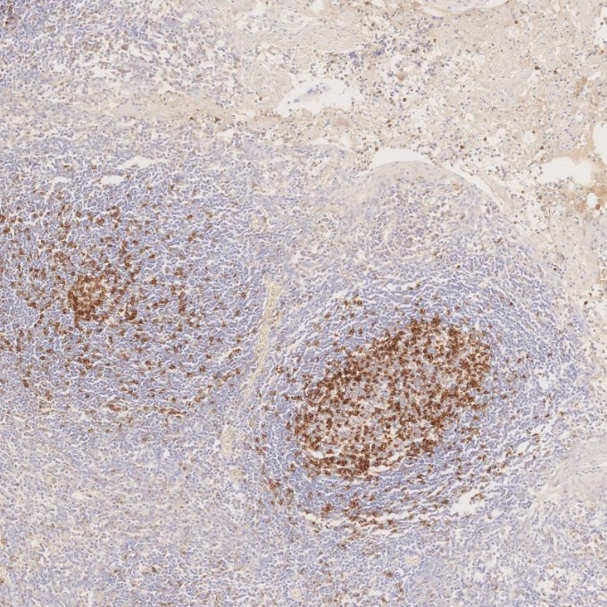IHC staining of human tonsillitis using 98068-1-RR Immunohistochemistry (IHC) staining of human tonsillitis tissue using Anti-Human PD-1/CD279 Rabbit Recombinant Antibody (98068-1-RR)