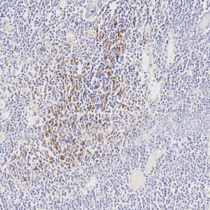 IHC staining of human lymphoma using 98068-1-RR Immunohistochemistry (IHC) staining of human lymphoma tissue using Anti-Human PD-1/CD279 Rabbit Recombinant Antibody (98068-1-RR)