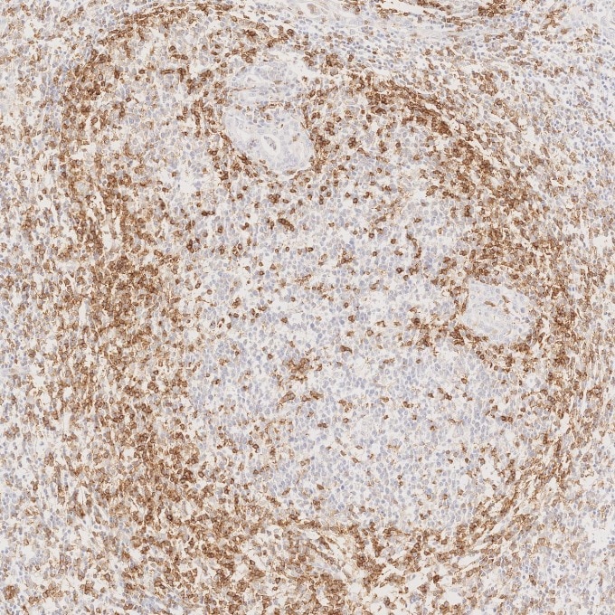 IHC staining of human lymphoma using 98068-1-RR Immunohistochemistry (IHC) staining of human lymphoma tissue using Anti-Human PD-1/CD279 Rabbit Recombinant Antibody (98068-1-RR)