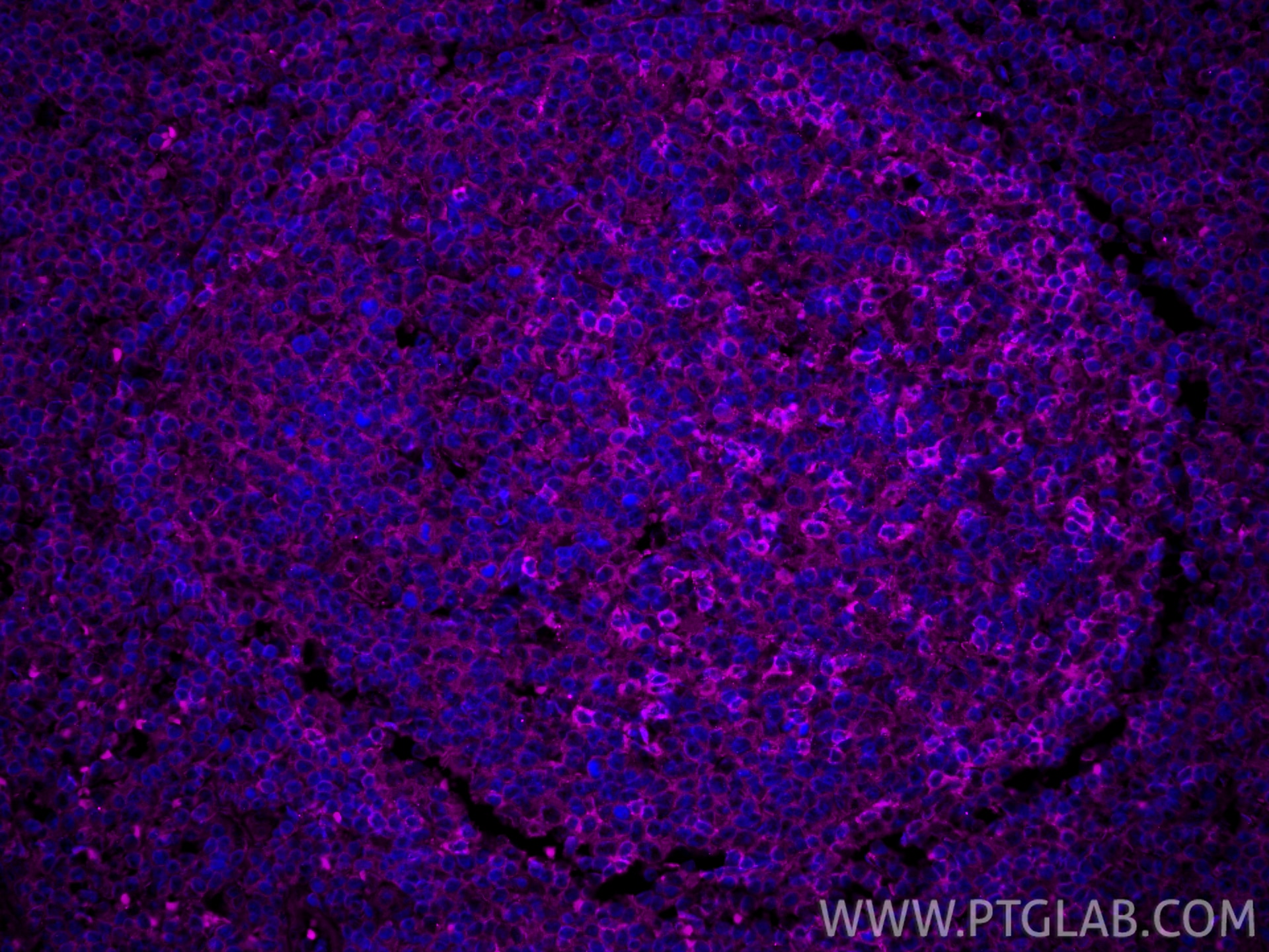 IF Staining of human tonsillitis using APC-66220 Immunofluorescence (IF) / fluorescent staining of human tonsillitis tissue using APC-conjugated PD-1/CD279 Monoclonal antibody (APC-66220)