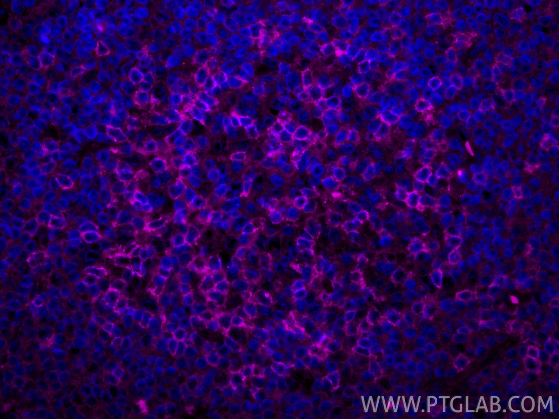 IF Staining of human tonsillitis using APC-66220 Immunofluorescence (IF) / fluorescent staining of human tonsillitis tissue using APC-conjugated PD-1/CD279 Monoclonal antibody (APC-66220)