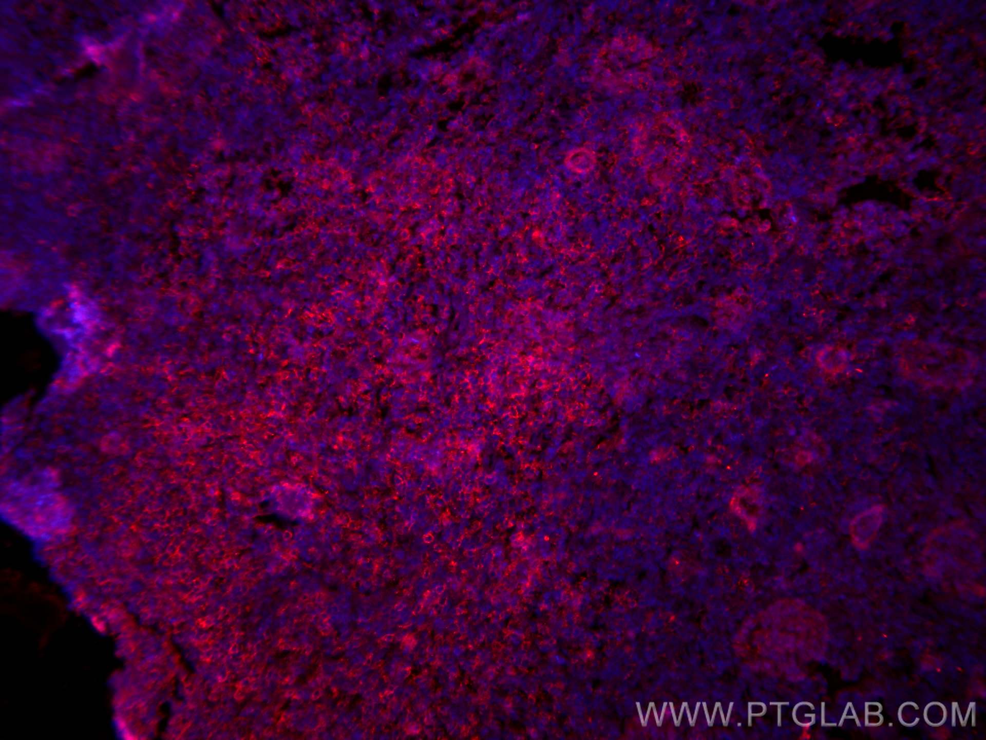 Immunofluorescence (IF) / fluorescent staining of human lymphoma tissue using CoraLite®594-conjugated PD-1/CD279 Monoclonal anti (CL594-66220)