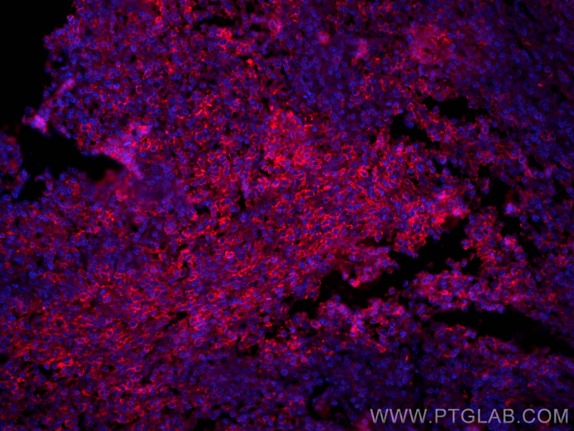 Immunofluorescence (IF) / fluorescent staining of human lymphoma tissue using CoraLite®594-conjugated PD-1/CD279 Monoclonal anti (CL594-66220)