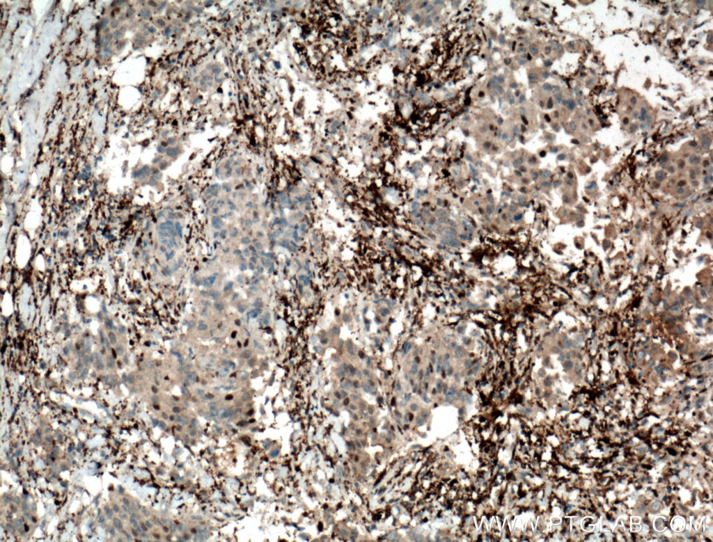 Immunohistochemistry (IHC) staining of human breast cancer tissue using PD-ECGF Polyclonal antibody (12383-1-AP)