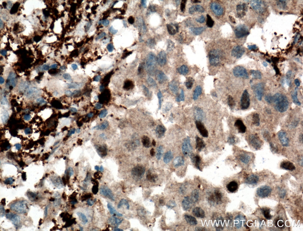 Immunohistochemistry (IHC) staining of human breast cancer tissue using PD-ECGF Polyclonal antibody (12383-1-AP)