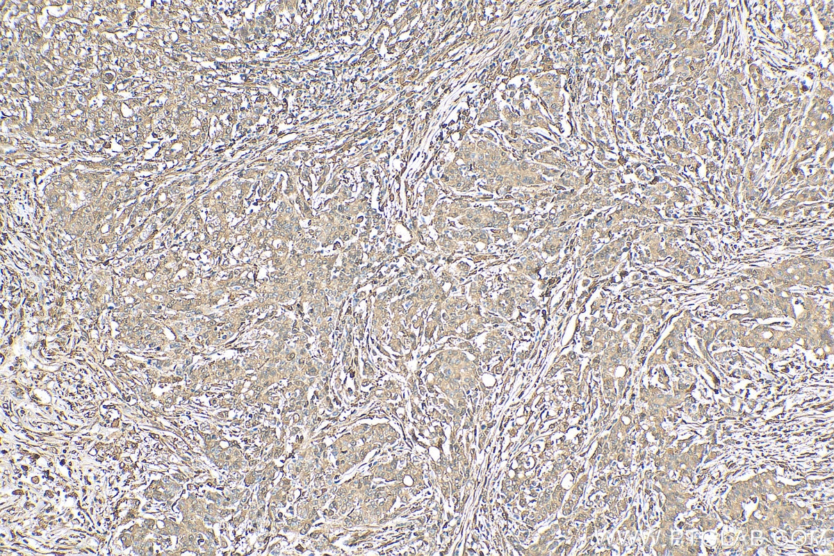 Immunohistochemistry (IHC) staining of human stomach cancer tissue using PD-ECGF Polyclonal antibody (12383-1-AP)