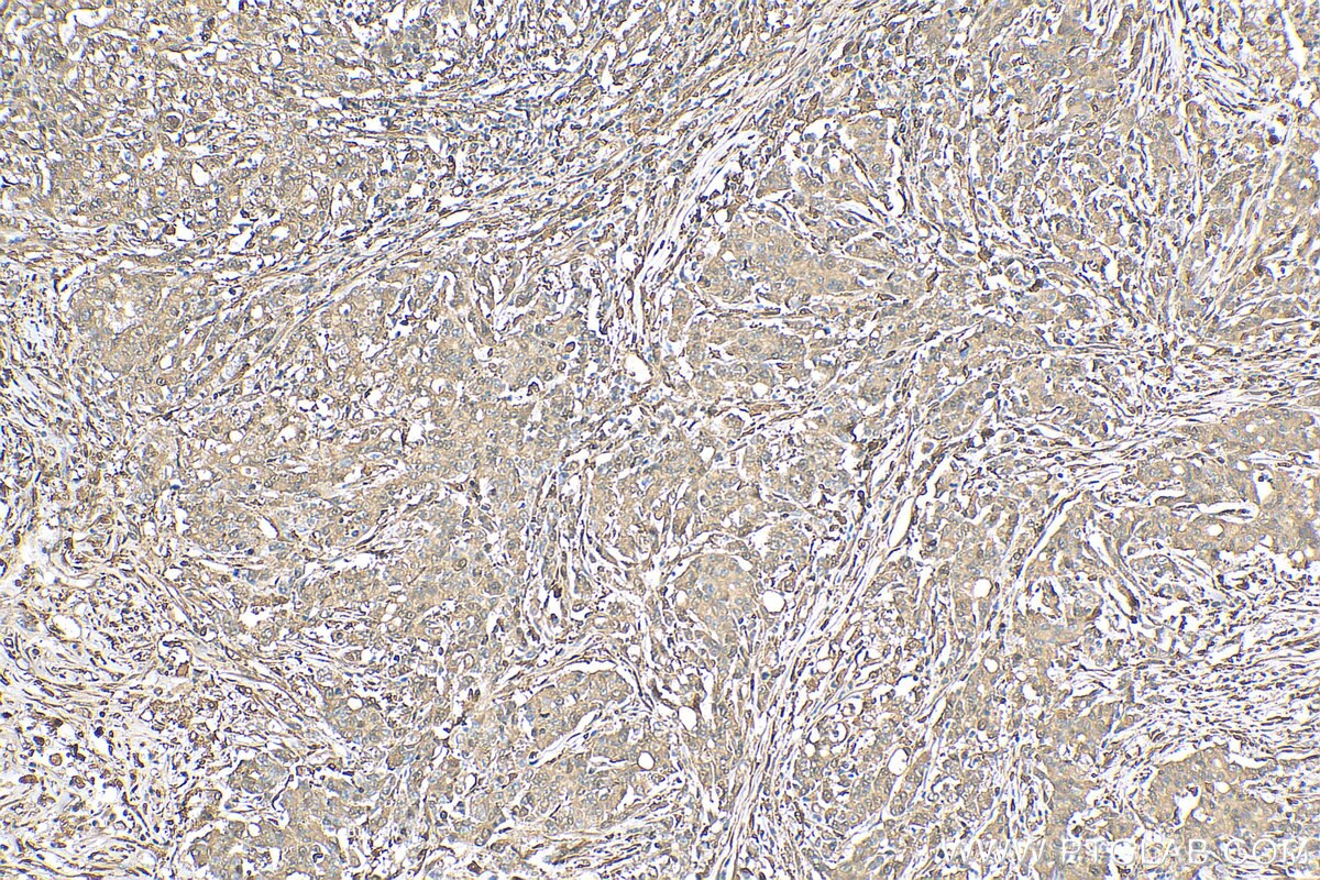 Immunohistochemistry (IHC) staining of human stomach cancer tissue using PD-ECGF Polyclonal antibody (12383-1-AP)