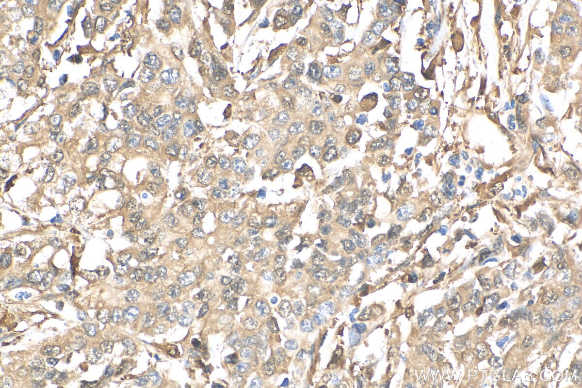 Immunohistochemistry (IHC) staining of human stomach cancer tissue using PD-ECGF Polyclonal antibody (12383-1-AP)