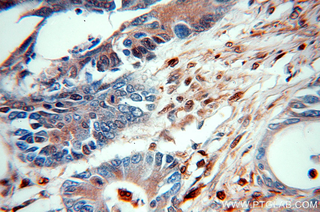 Immunohistochemistry (IHC) staining of human ovary tumor tissue using PD-ECGF Polyclonal antibody (12383-1-AP)