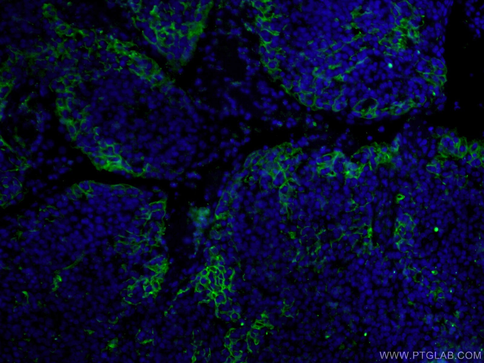 IF Staining of human tonsillitis using 28076-1-AP