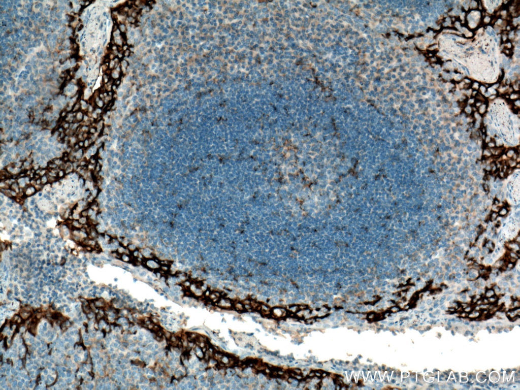 Immunohistochemistry (IHC) staining of human tonsillitis tissue using PD-L1/CD274 (C-terminal) Polyclonal antibody (28076-1-AP)