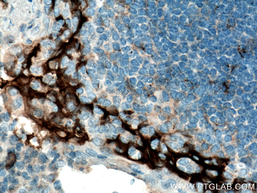 Immunohistochemistry (IHC) staining of human tonsillitis tissue using PD-L1/CD274 (C-terminal) Polyclonal antibody (28076-1-AP)