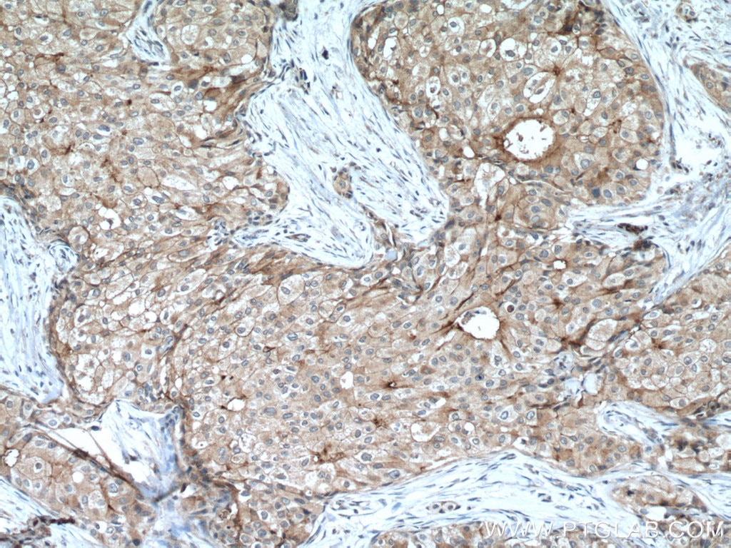 Immunohistochemistry (IHC) staining of human breast cancer tissue using PD-L1/CD274 (C-terminal) Polyclonal antibody (28076-1-AP)