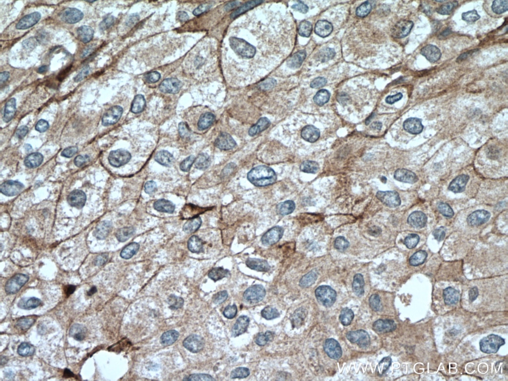Immunohistochemistry (IHC) staining of human breast cancer tissue using PD-L1/CD274 (C-terminal) Polyclonal antibody (28076-1-AP)