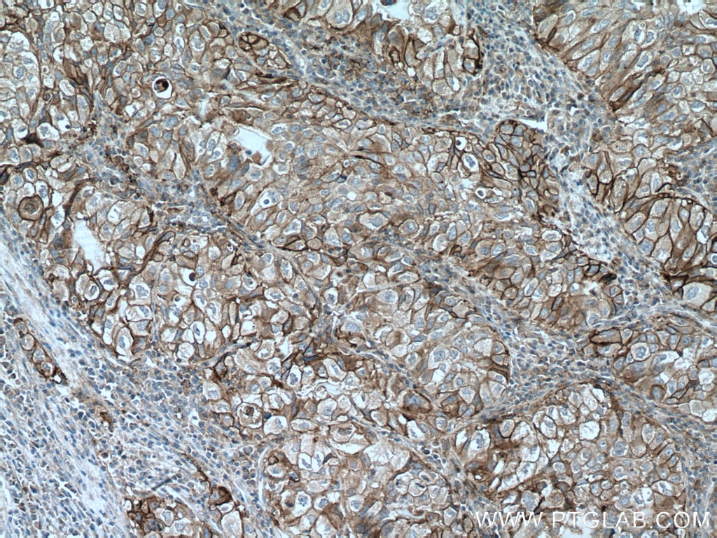 Immunohistochemistry (IHC) staining of human lung cancer tissue using PD-L1/CD274 (C-terminal) Polyclonal antibody (28076-1-AP)