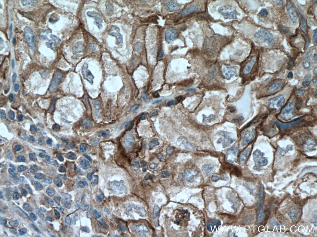 Immunohistochemistry (IHC) staining of human lung cancer tissue using PD-L1/CD274 (C-terminal) Polyclonal antibody (28076-1-AP)
