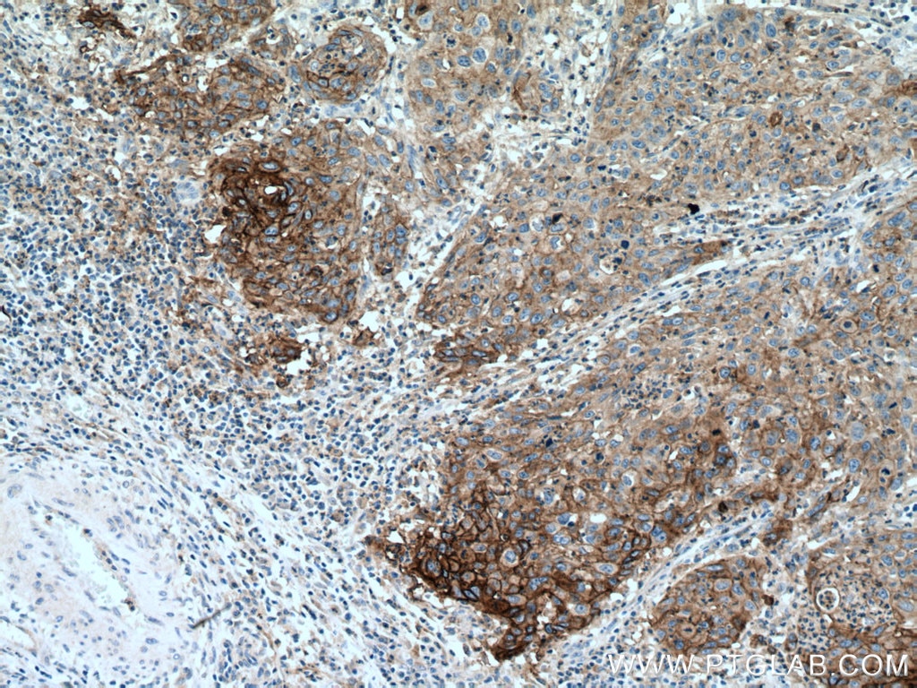 Immunohistochemistry (IHC) staining of human cervical cancer tissue using PD-L1/CD274 (C-terminal) Polyclonal antibody (28076-1-AP)