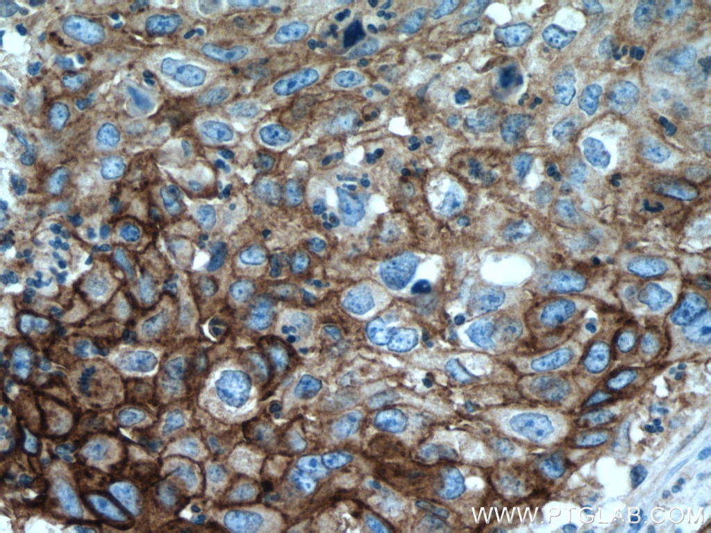 Immunohistochemistry (IHC) staining of human cervical cancer tissue using PD-L1/CD274 (C-terminal) Polyclonal antibody (28076-1-AP)