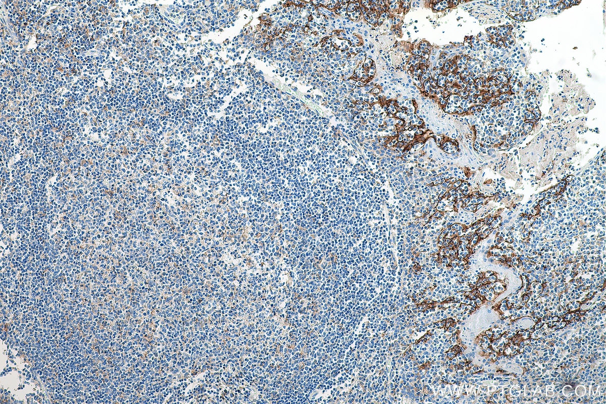 Immunohistochemistry (IHC) staining of human tonsillitis tissue using PD-L1/CD274 (C-terminal) Polyclonal antibody (28076-1-AP)