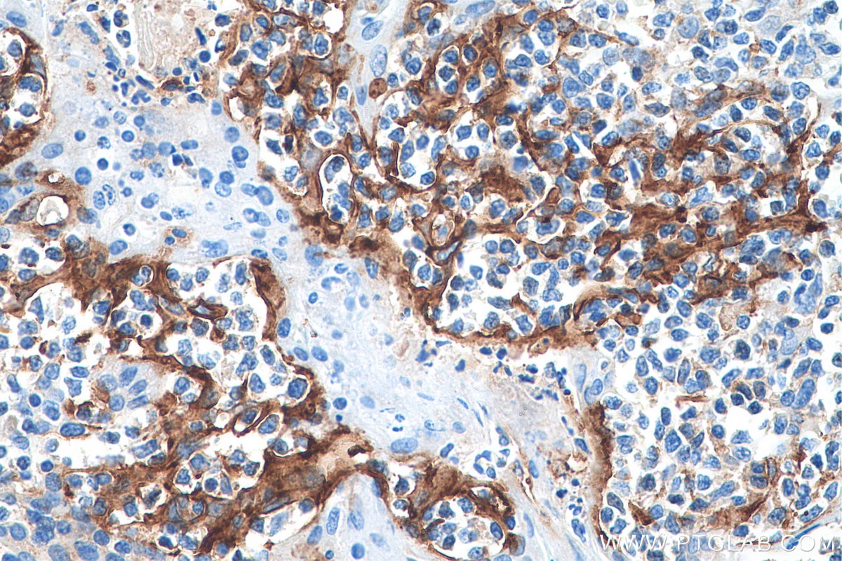 Immunohistochemistry (IHC) staining of human tonsillitis tissue using PD-L1/CD274 (C-terminal) Polyclonal antibody (28076-1-AP)