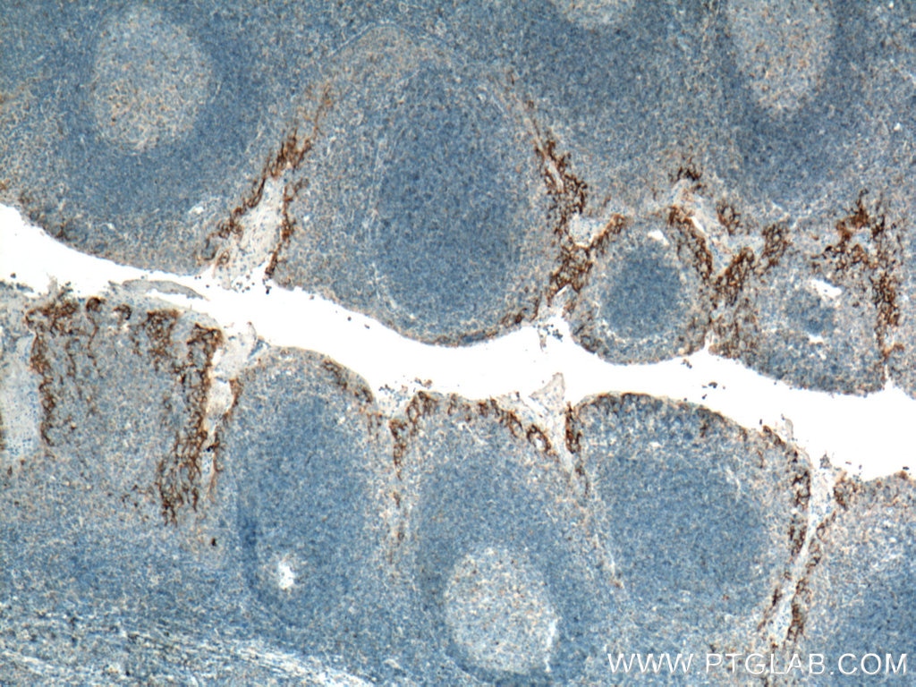 IHC staining of human tonsillitis using 66248-1-Ig