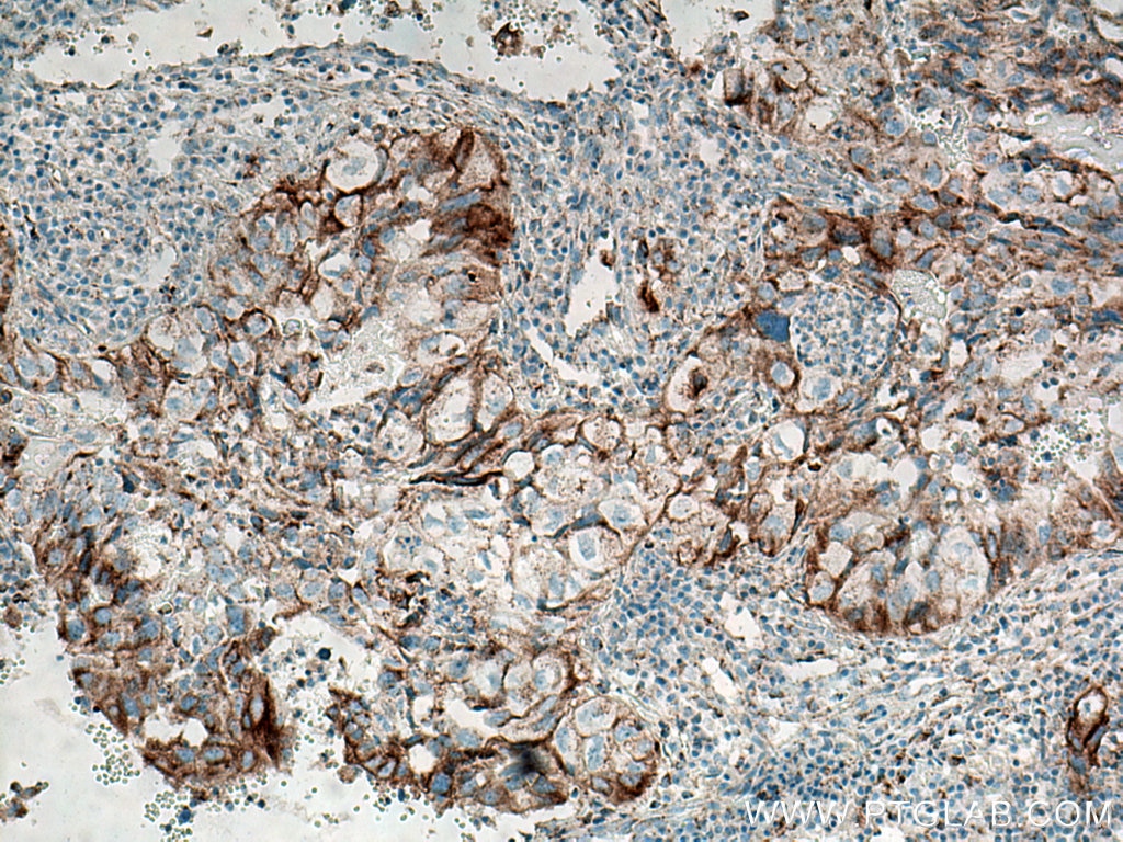 Immunohistochemistry (IHC) staining of human lung cancer tissue using PD-L1/CD274 Monoclonal antibody (66248-1-Ig)