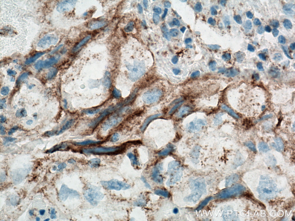 Immunohistochemistry (IHC) staining of human lung cancer tissue using PD-L1/CD274 Monoclonal antibody (66248-1-Ig)