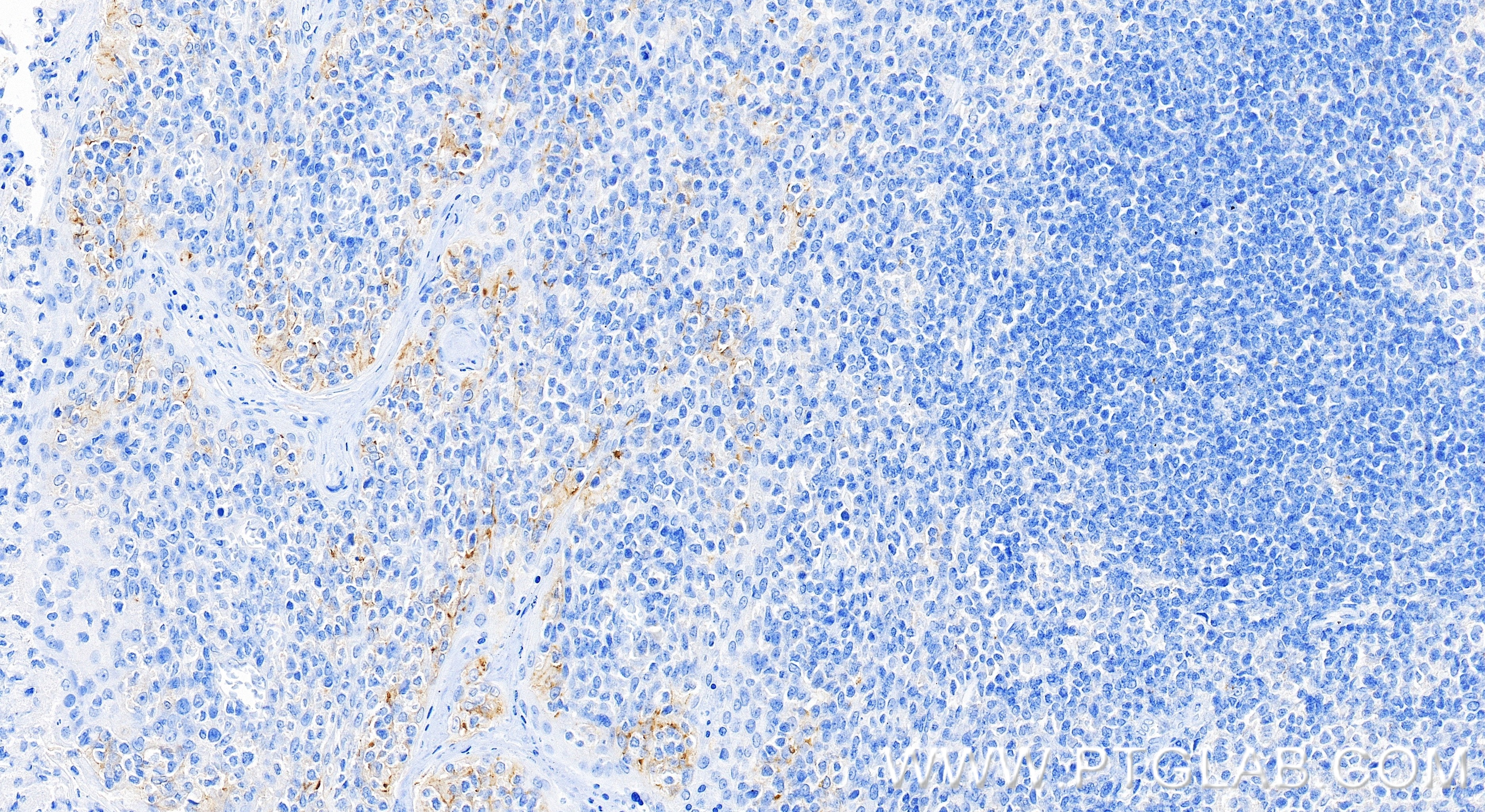 Immunohistochemistry (IHC) staining of human tonsillitis tissue using PD-L1/CD274 Recombinant monoclonal antibody (83600-2-RR)