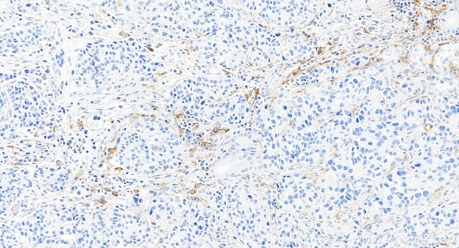 IHC staining of human stomach cancer using 85229-23-RR Immunohistochemistry (IHC) staining of human stomach cancer tissue using PD-L1/CD274 Recombinant monoclonal antibody (85229-23-RR)