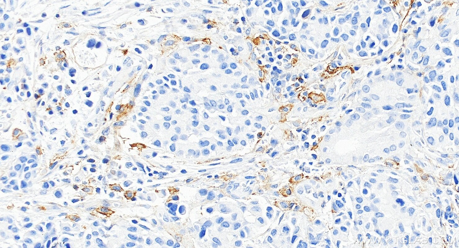 IHC staining of human stomach cancer using 85229-23-RR Immunohistochemistry (IHC) staining of human stomach cancer tissue using PD-L1/CD274 Recombinant monoclonal antibody (85229-23-RR)