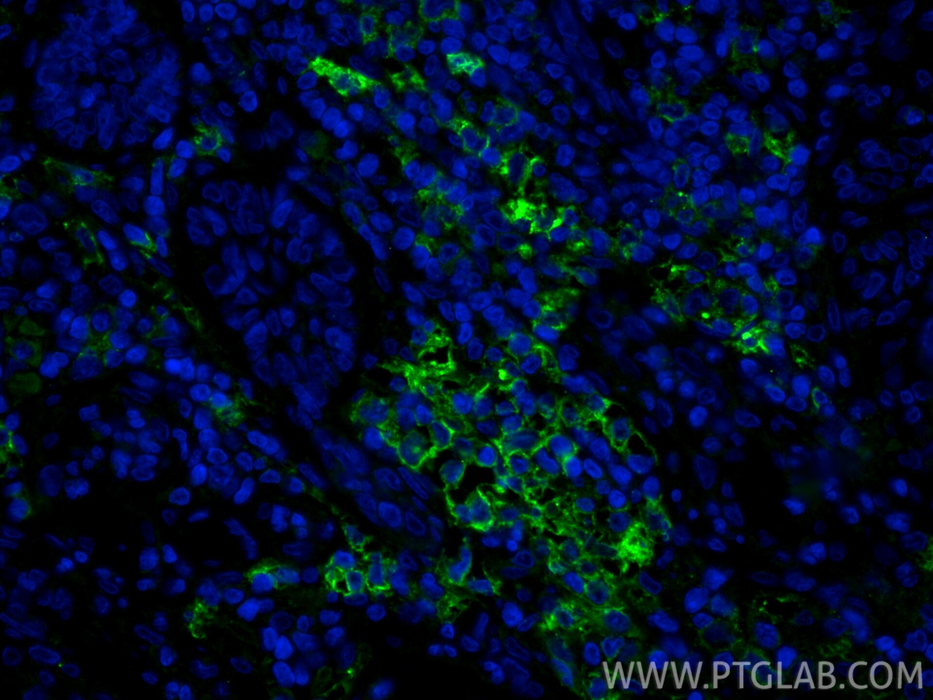 IF Staining of human skin cancer using 85229-23-RR Immunofluorescence (IF) / fluorescent staining of human skin cancer tissue using PD-L1/CD274 Recombinant monoclonal antibody (85229-23-RR)