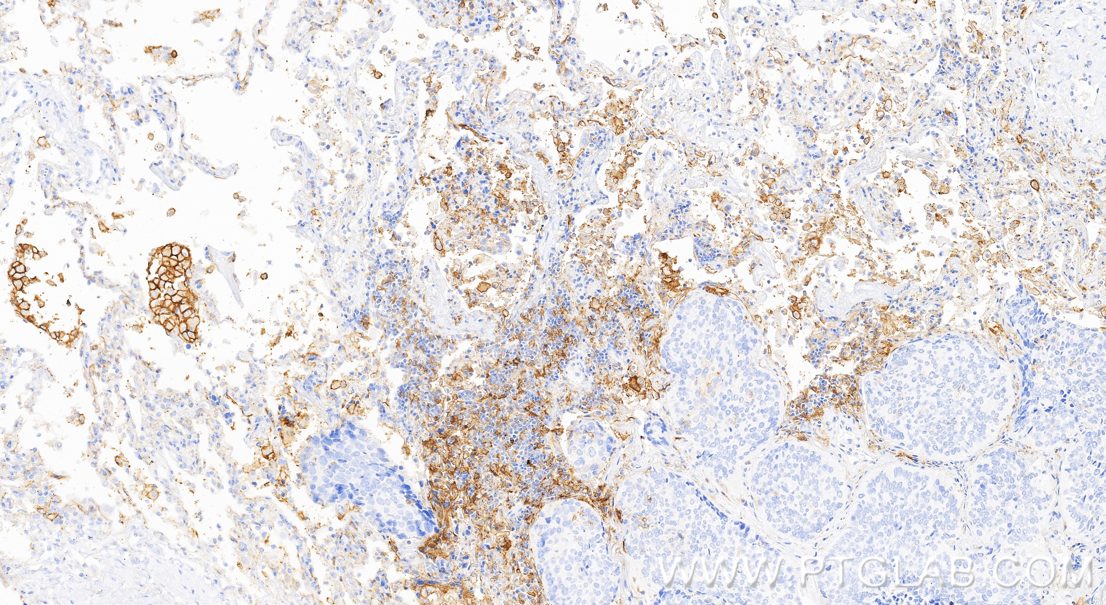 Immunohistochemistry (IHC) staining of human lung cancer tissue using PD-L1/CD274 Recombinant monoclonal antibody (85229-23-RR)