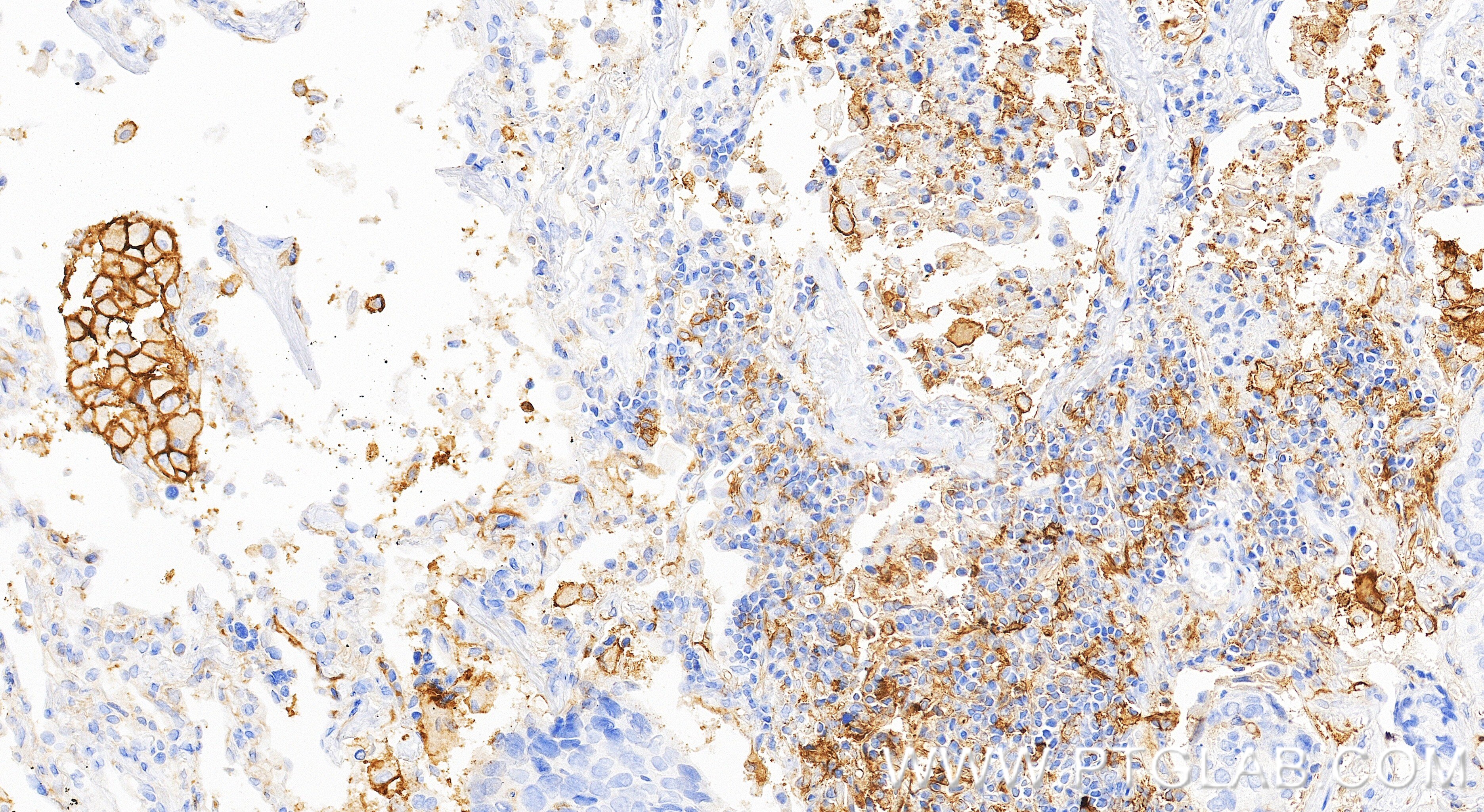 Immunohistochemistry (IHC) staining of human lung cancer tissue using PD-L1/CD274 Recombinant monoclonal antibody (85229-23-RR)