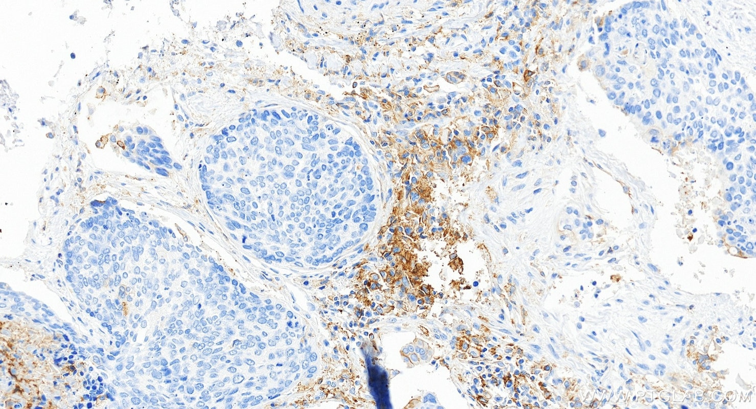 IHC staining of human lung cancer using 85229-23-RR Immunohistochemistry (IHC) staining of human lung cancer tissue using PD-L1/CD274 Recombinant monoclonal antibody (85229-23-RR)