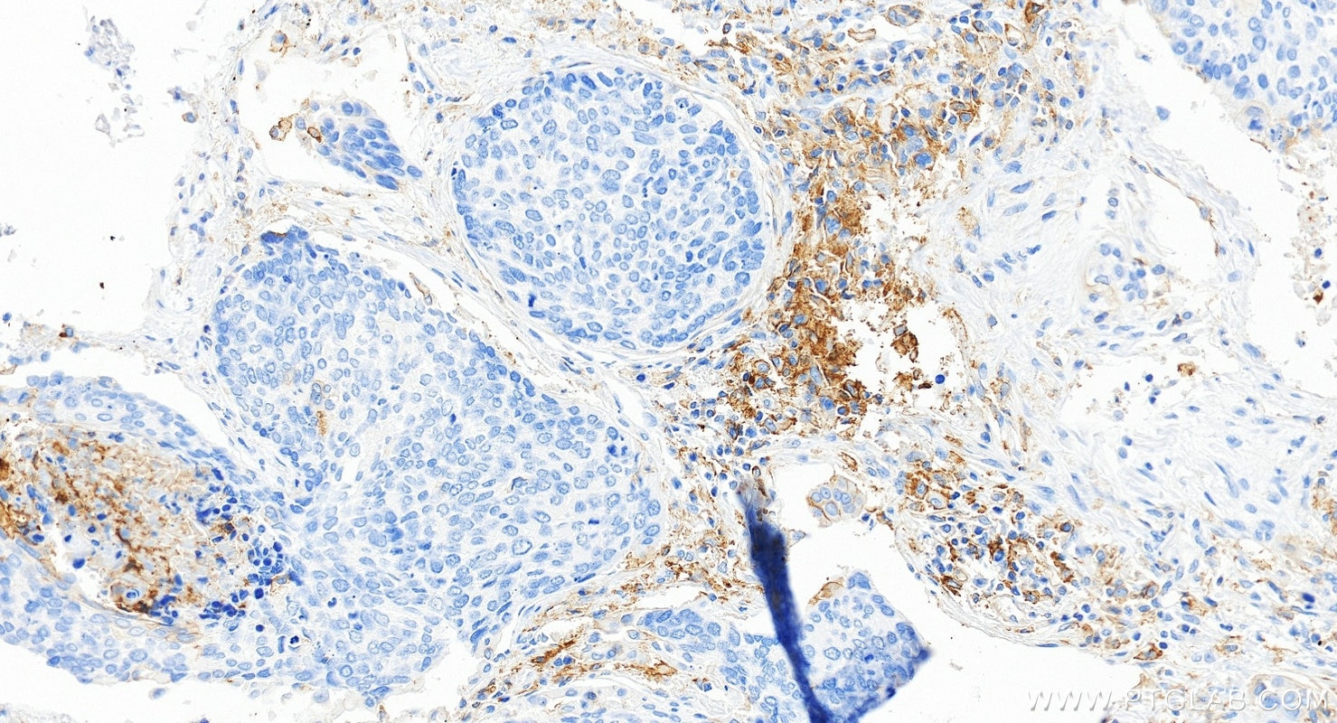 IHC staining of human lung cancer using 85229-23-RR Immunohistochemistry (IHC) staining of human lung cancer tissue using PD-L1/CD274 Recombinant monoclonal antibody (85229-23-RR)