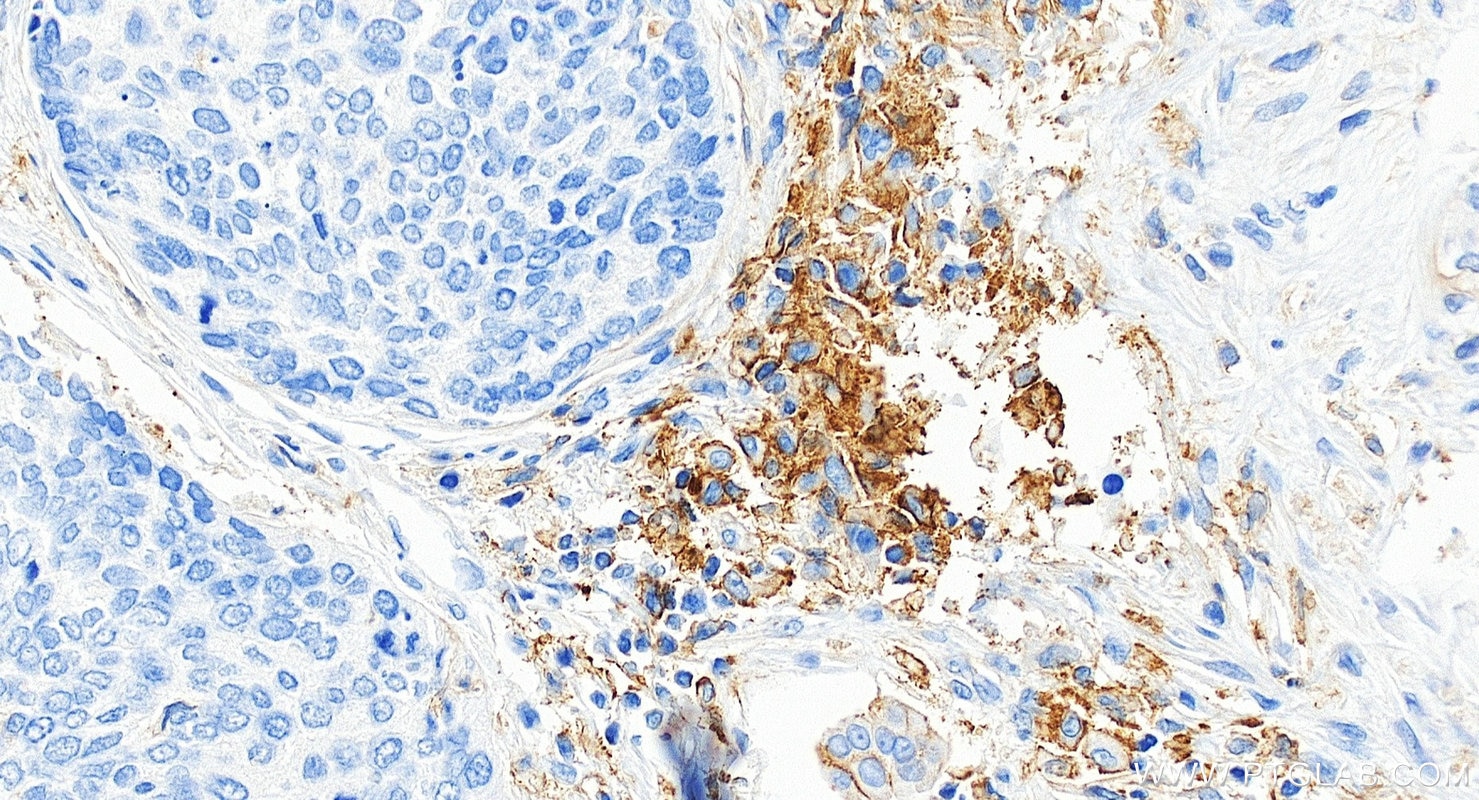 IHC staining of human lung cancer using 85229-23-RR Immunohistochemistry (IHC) staining of human lung cancer tissue using PD-L1/CD274 Recombinant monoclonal antibody (85229-23-RR)