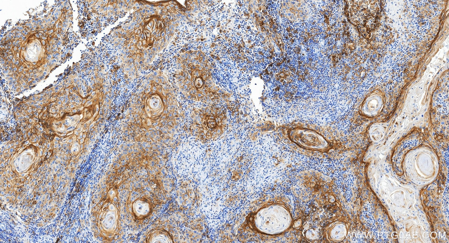 IHC staining of human skin cancer using 85229-23-RR Immunohistochemistry (IHC) staining of human skin cancer tissue using PD-L1/CD274 Recombinant monoclonal antibody (85229-23-RR)