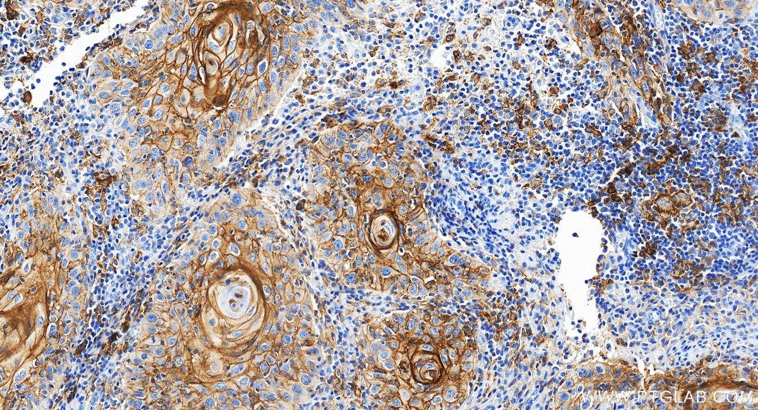 IHC staining of human skin cancer using 85229-23-RR Immunohistochemistry (IHC) staining of human skin cancer tissue using PD-L1/CD274 Recombinant monoclonal antibody (85229-23-RR)