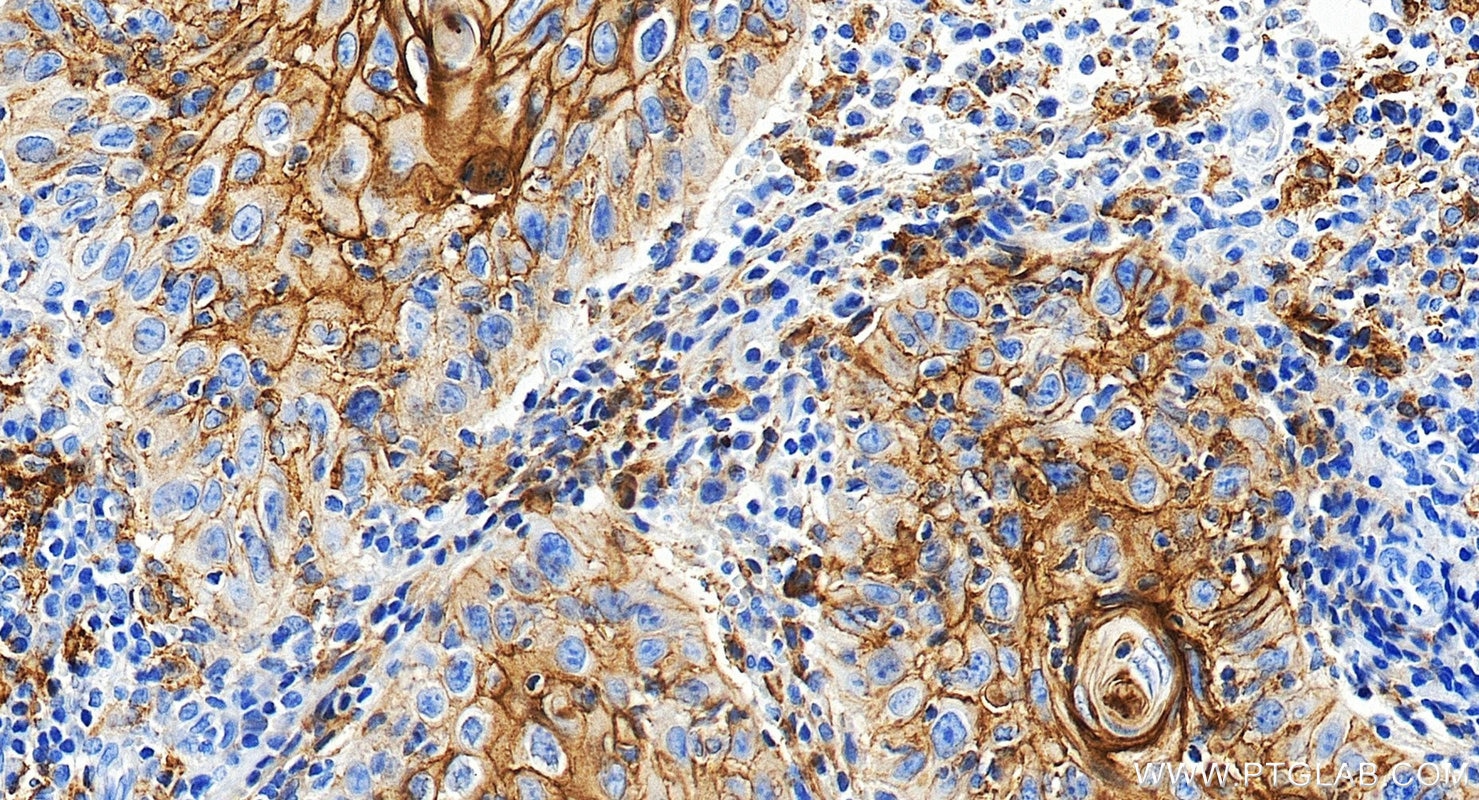 IHC staining of human skin cancer using 85229-23-RR Immunohistochemistry (IHC) staining of human skin cancer tissue using PD-L1/CD274 Recombinant monoclonal antibody (85229-23-RR)