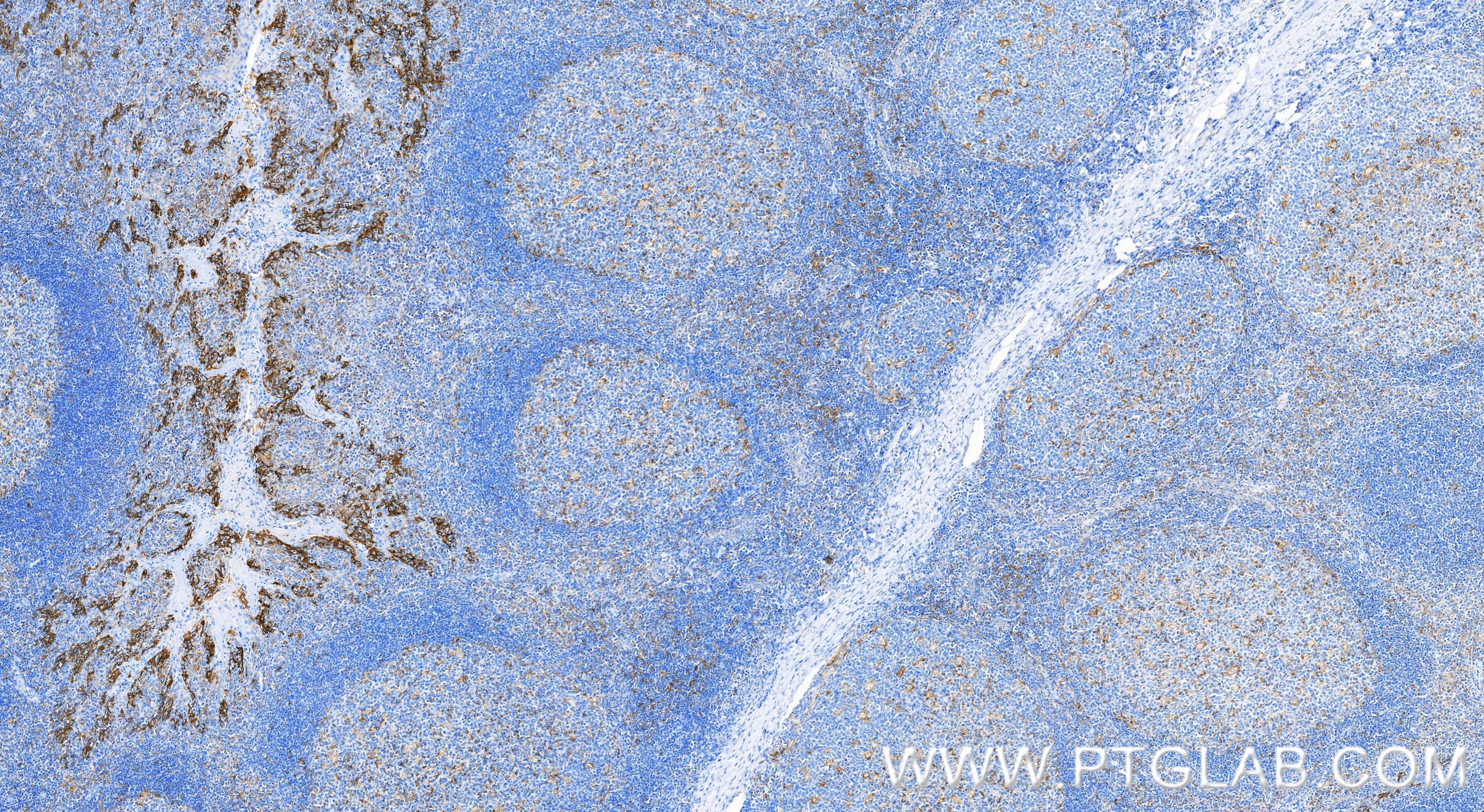 Immunohistochemistry (IHC) staining of human tonsillitis tissue using PD-L1/CD274 Recombinant monoclonal antibody (85229-23-RR)