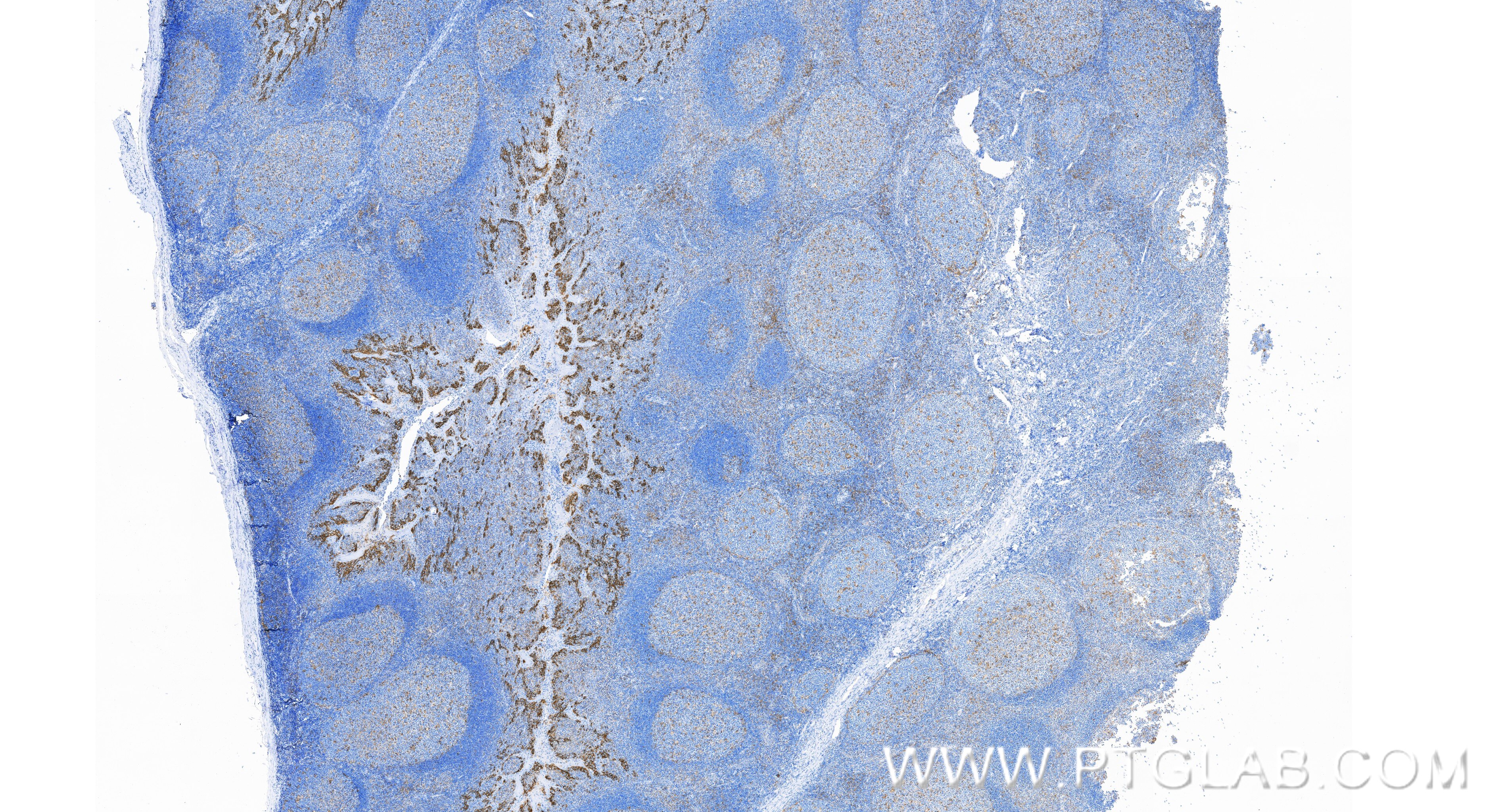 Immunohistochemistry (IHC) staining of human tonsillitis tissue using PD-L1/CD274 Recombinant monoclonal antibody (85229-23-RR)