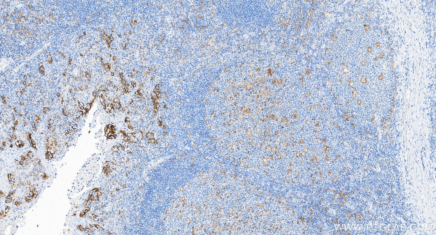 Immunohistochemistry (IHC) staining of human tonsillitis tissue using PD-L1/CD274 Recombinant monoclonal antibody (85229-23-RR)
