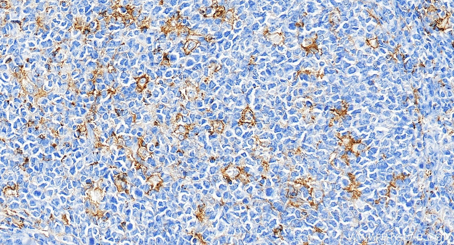 IHC staining of human tonsillitis using 85229-23-RR Immunohistochemistry (IHC) staining of human tonsillitis tissue using PD-L1/CD274 Recombinant monoclonal antibody (85229-23-RR)