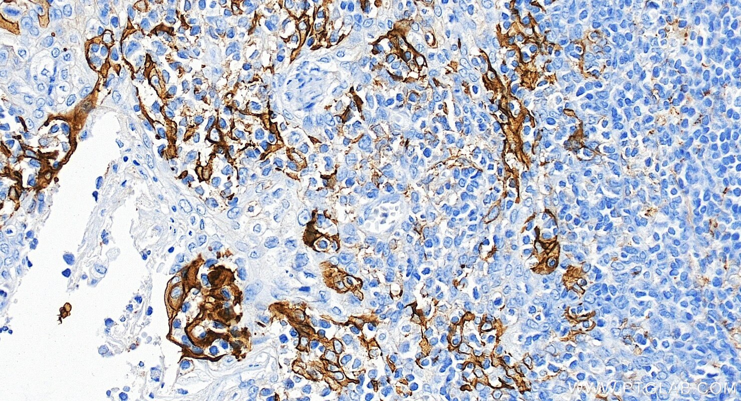 IHC staining of human tonsillitis using 85229-23-RR Immunohistochemistry (IHC) staining of human tonsillitis tissue using PD-L1/CD274 Recombinant monoclonal antibody (85229-23-RR)