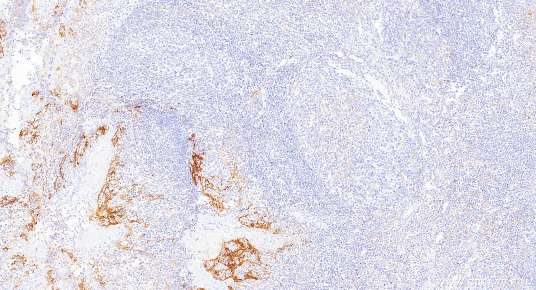 IHC staining of human tonsillitis using Biotin-85229-23 Immunohistochemistry (IHC) staining of human tonsillitis tissue using Biotin-conjugated PD-L1/CD274 Recombinant monoclon (Biotin-85229-23)