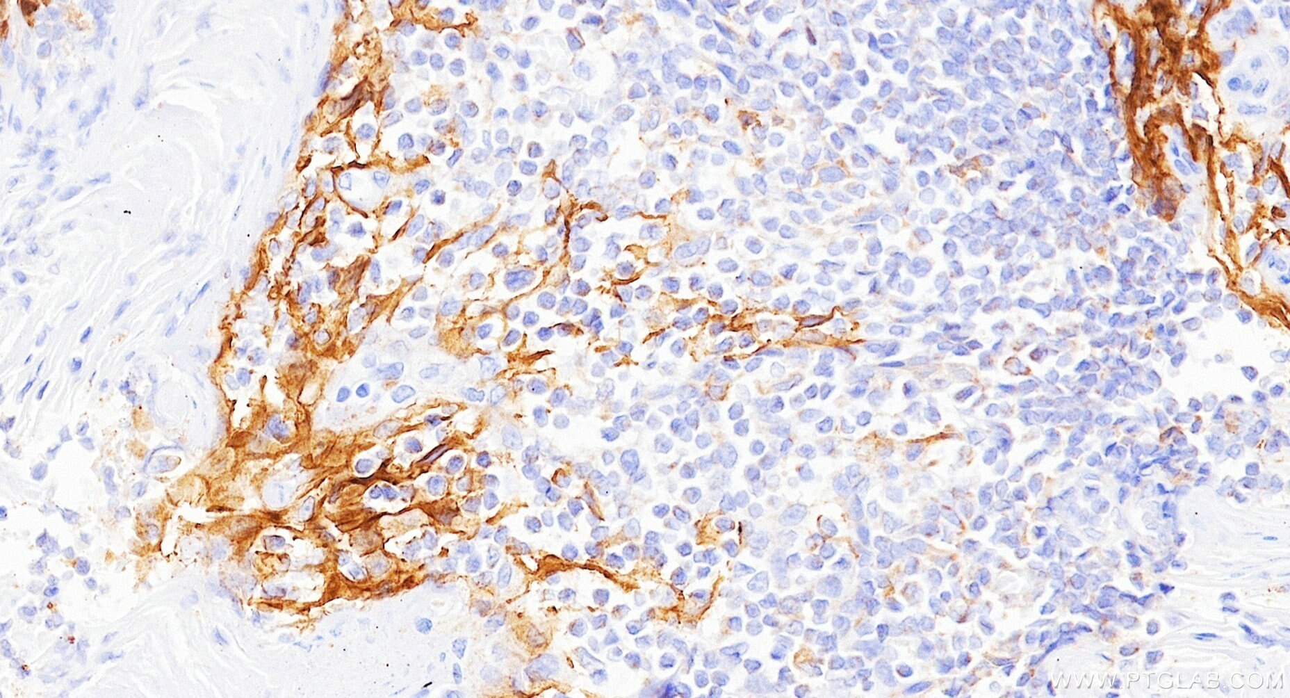 IHC staining of human tonsillitis using Biotin-85229-23 Immunohistochemistry (IHC) staining of human tonsillitis tissue using Biotin-conjugated PD-L1/CD274 Recombinant monoclon (Biotin-85229-23)