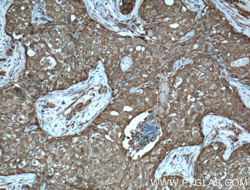 Immunohistochemistry (IHC) staining of human breast cancer tissue using PDAP1 Polyclonal antibody (15081-1-AP)